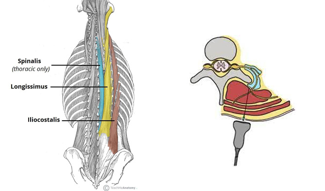 با عضلات نگهدارنده ستون فقرات(Erector-Spinae-Muscles) آشنا شویم