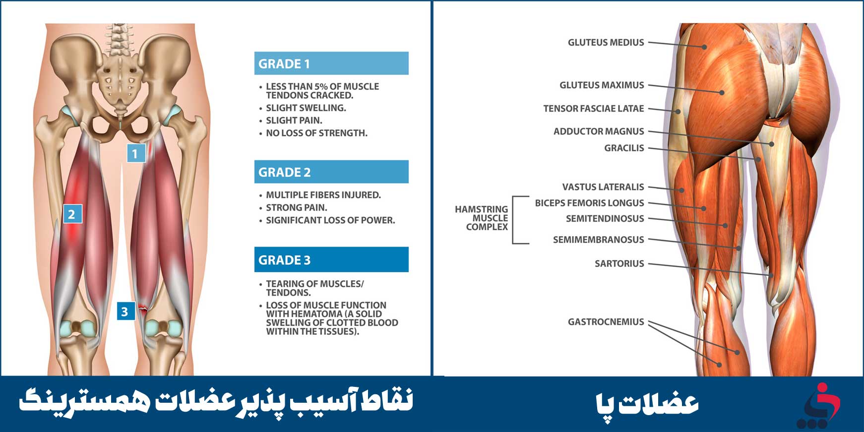 عضلات پا و نقاط آسیب پذیر عضلات همسترینگ را بشناسیم